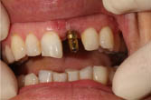 Implantatabforumung (Abformpfosten)