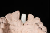 Individuelles Zirkoniumoxid Abutment