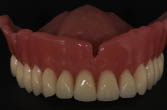 Totalprothese